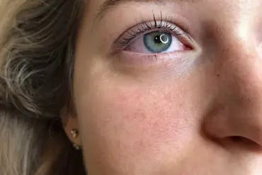 Microneedling con Jive Serum