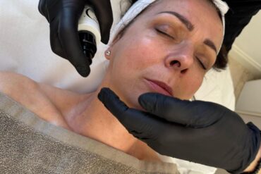 Microneedling con Jive Serum